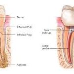 endodontic treatment2