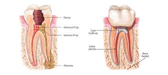 endodontic treatment2