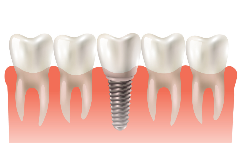 Dental Implant Is the most Appropriate Choice to Replace Tooth Loss