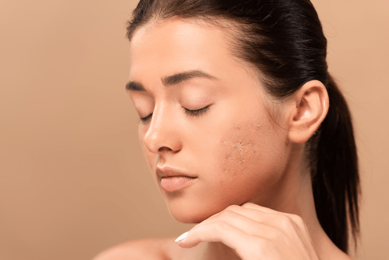 Flawless Skin Unleashed: Non-Invasive Acne Scar Treatments