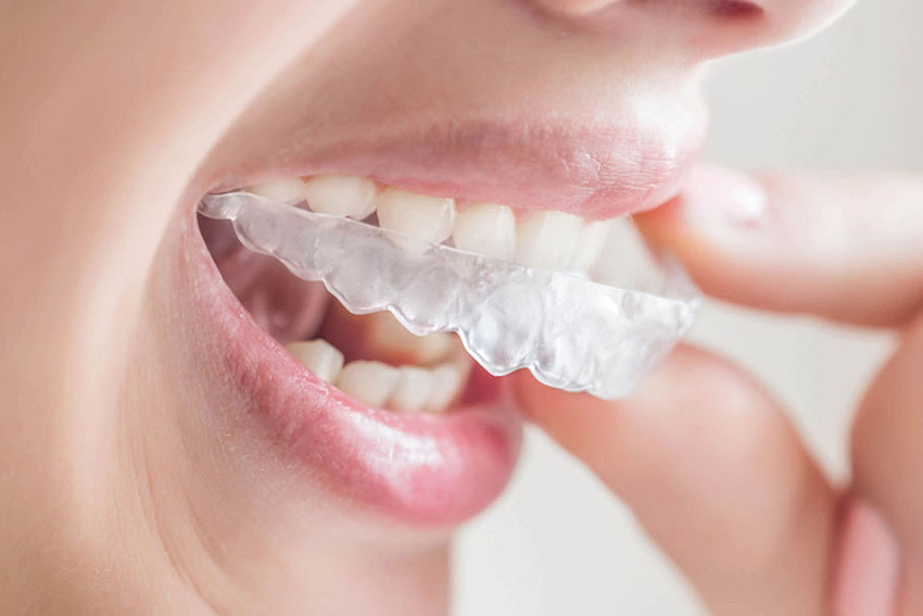 Invisalign London for straightening teeth in children and teenagers